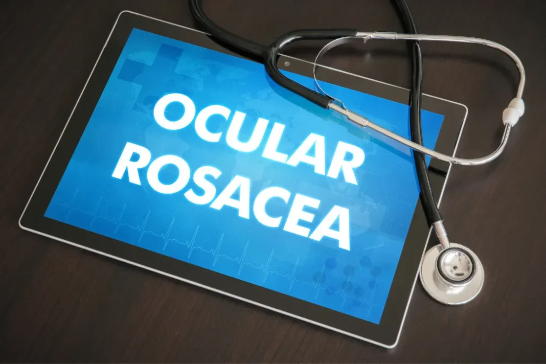 Ocular Rosacea.